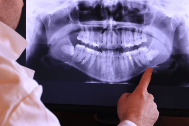 Best Emergency Wisdom Teeth Removal in Bamberg, SC