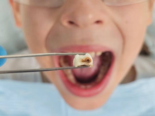Best Emergency Tooth Extraction in Bamberg, SC